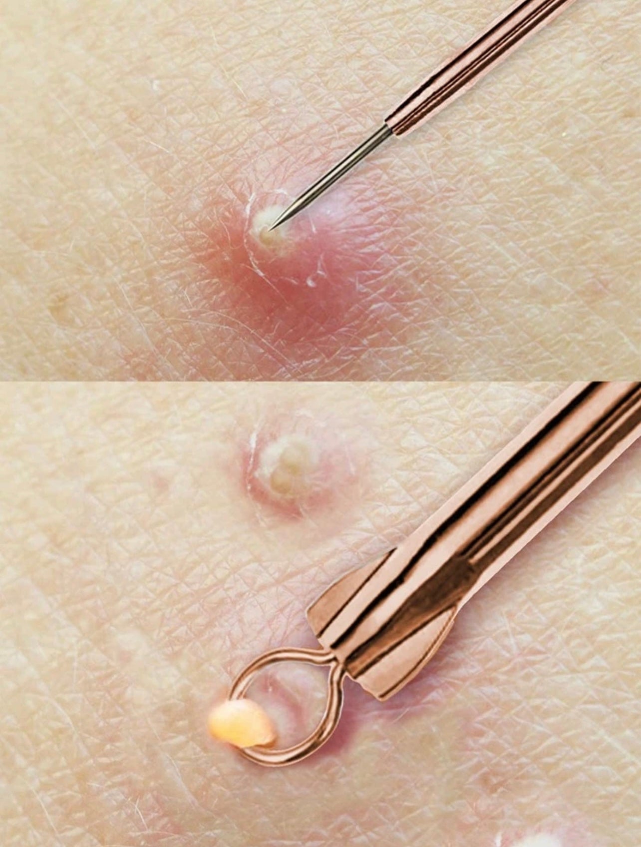 4 Pieces Needles for acne and blackheads.
